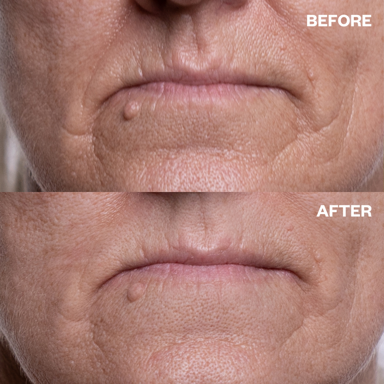 Mouth Wrinkle Patch - 2 patches