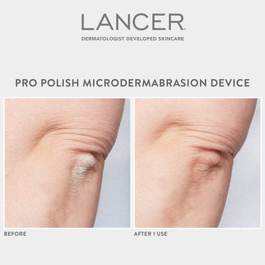 Pro Polish Microdermabrasion Device