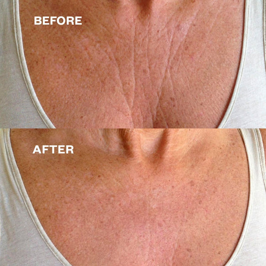 Chest Wrinkle Patch - 1 patch