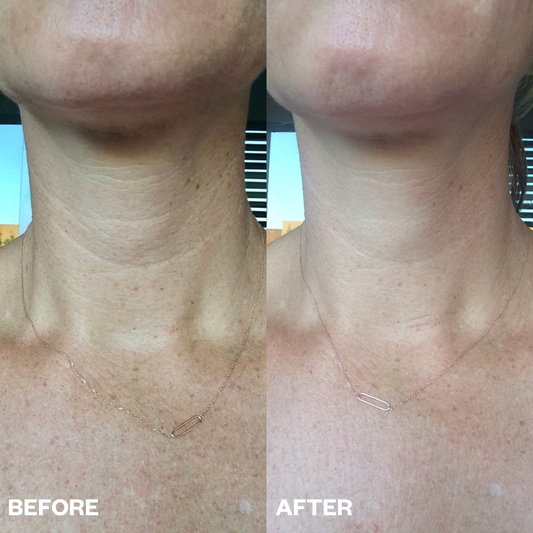Neck Wrinkle Patch - 1 patch